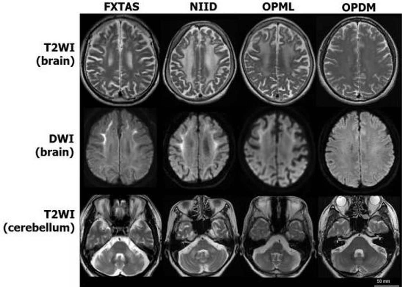 4 rare diseases characterized by similar neurodegenerative symptoms. Patients with fragile X tremor/ataxia syndrome (FXTAS), neuronal intranuclear inclusion disease (NIID) and oculopharyngeal myopathy with leukoencephalopathy (OPML) have similar brain MRIs. Patients with oculopharyngodistal myopathy (OPDM) have normal brain scans but muscle tissue that's similar to OPML patients
