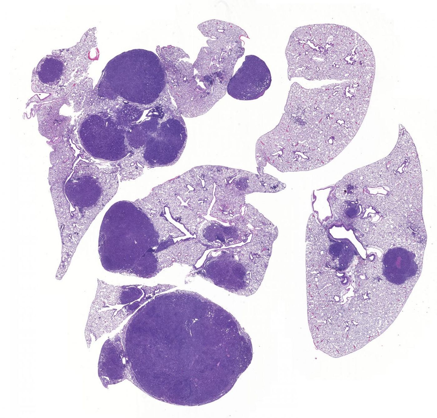 Image of lung cancer shows normal lung (light purple) and tumors (dark purple). Inactivation of SIK1 and SIK3 leads to tumor growth and inflammation, revealing for the first time that SIK kinases mediate key functions of LKB1 in preventing lung cancer. / Credit: Salk Institute