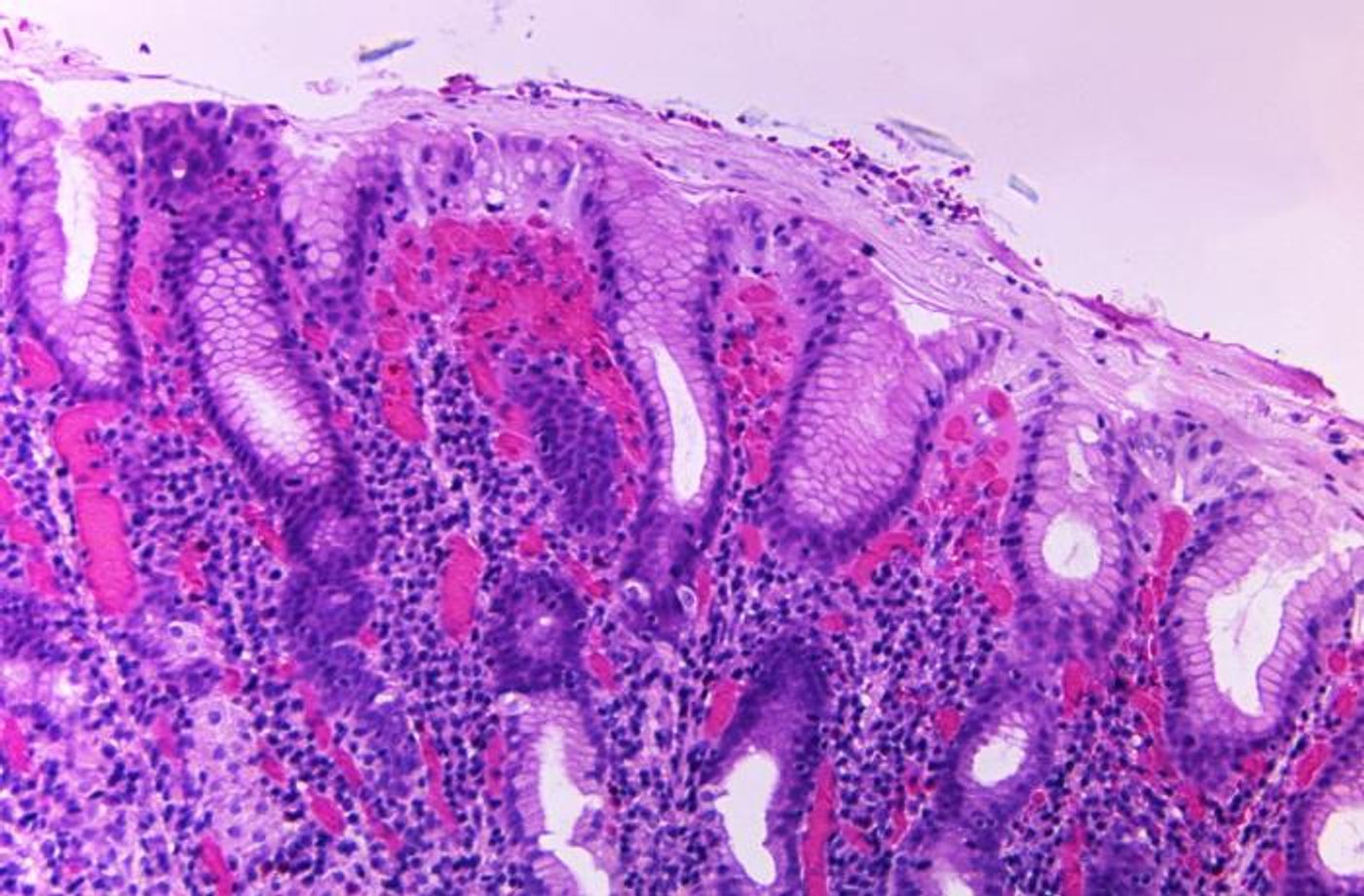 A photomicrograph of a gastric biopsy specimen from a cholera patient, revealing acute and chronic gastritis; Vibrio cholerae bacteria are thought to multiply in the overlying mucus membrane of the gastric mucosal epithelium. / Credit: CDC/ Dr. Gangarosa