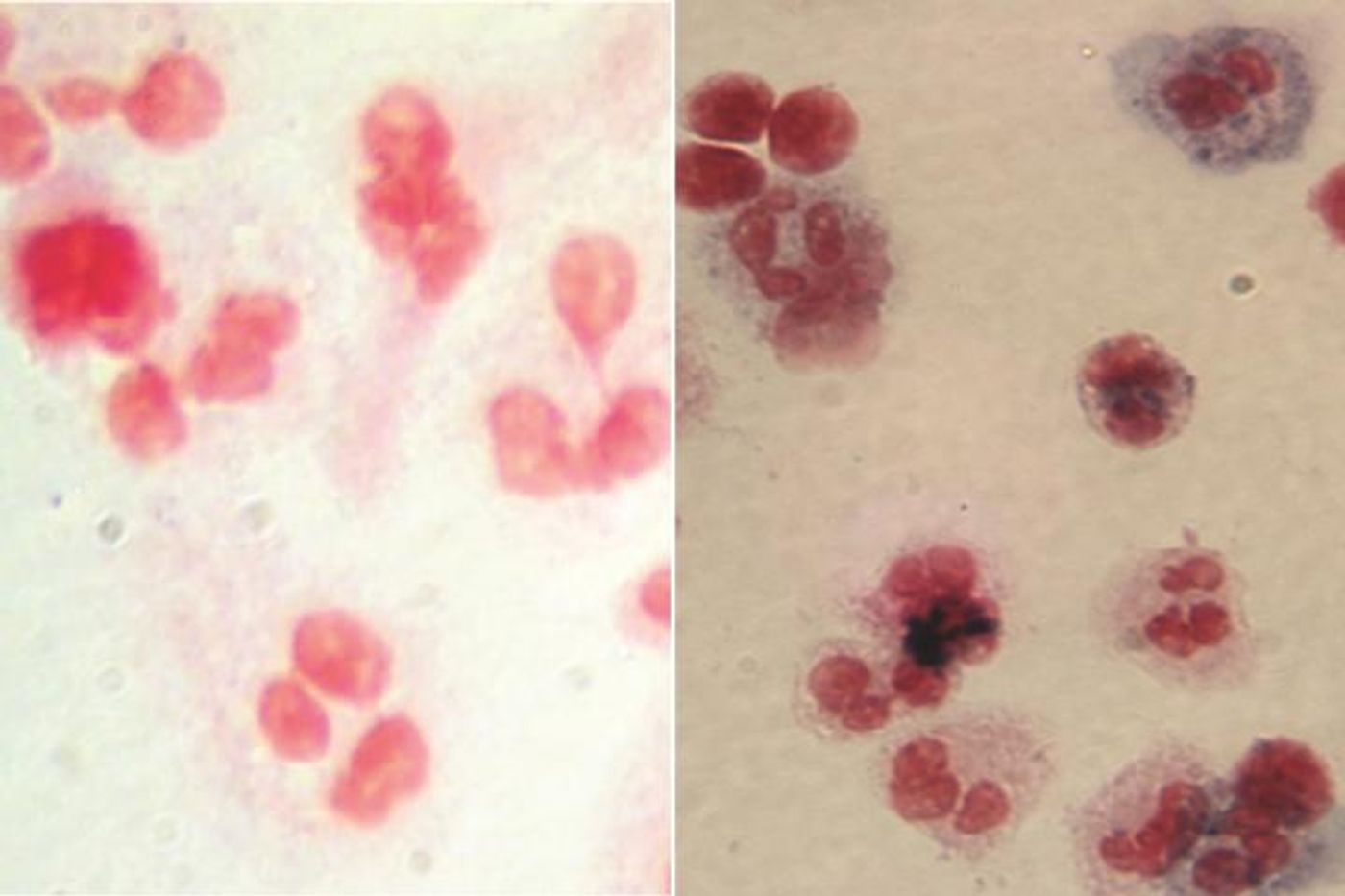 At left, image shows white blood cells (red) from one of the X-CGD clinical trial participants before gene therapy. At right, after gene therapy, white blood cells from the same patient show the presence of the chemicals (blue) needed to attack and destroy bacteria and fungus. Credit:  UCLA Broad Stem Cell Research Center/Nature Medicine