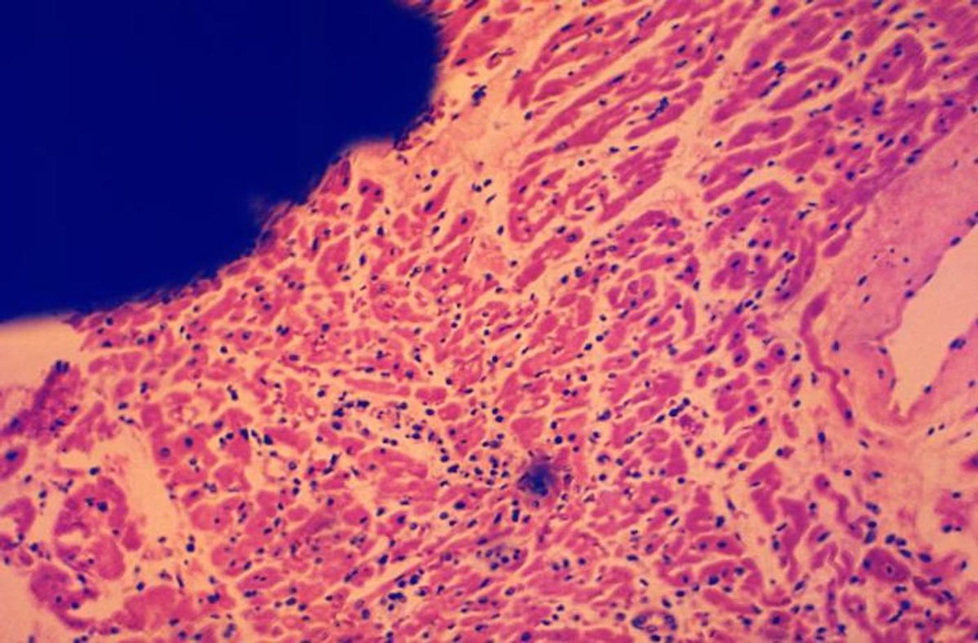 A photomicrograph of a section of myocardial tissue, specifically in an area of myocarditis / Credit: CDC/ Dr. Flynt