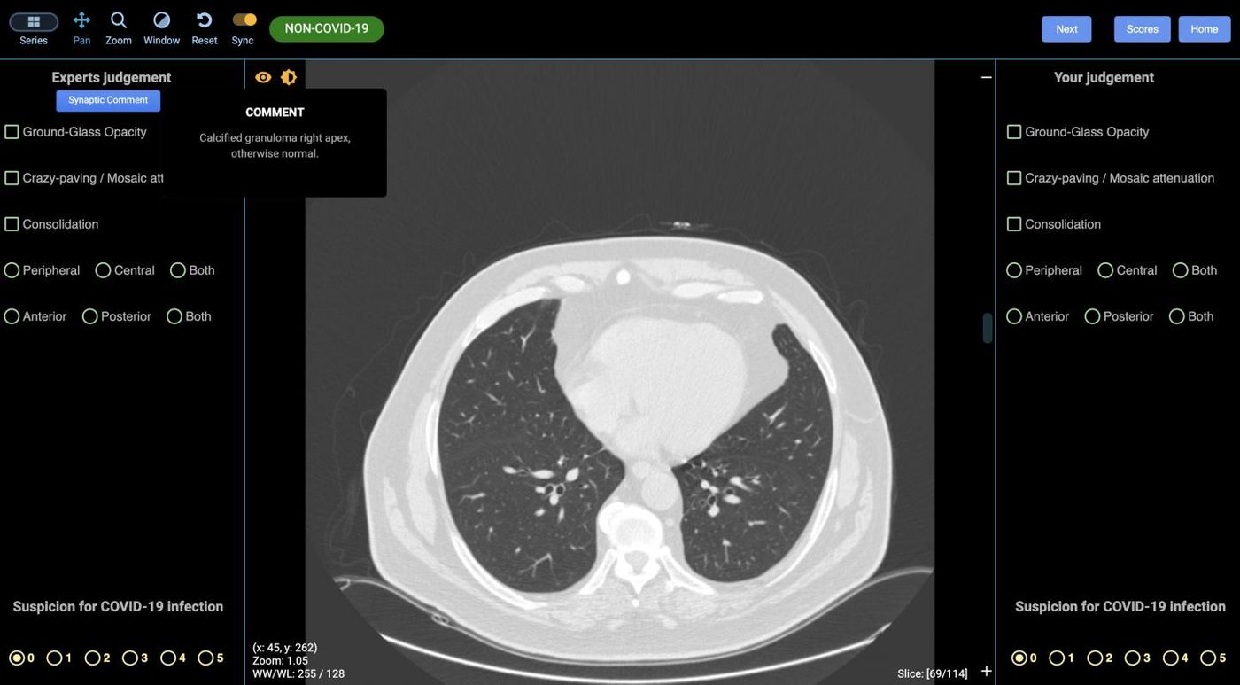 An image from the DetectED-X platform of a lung with no signs of COVID-19 / Credit: DetectED-X