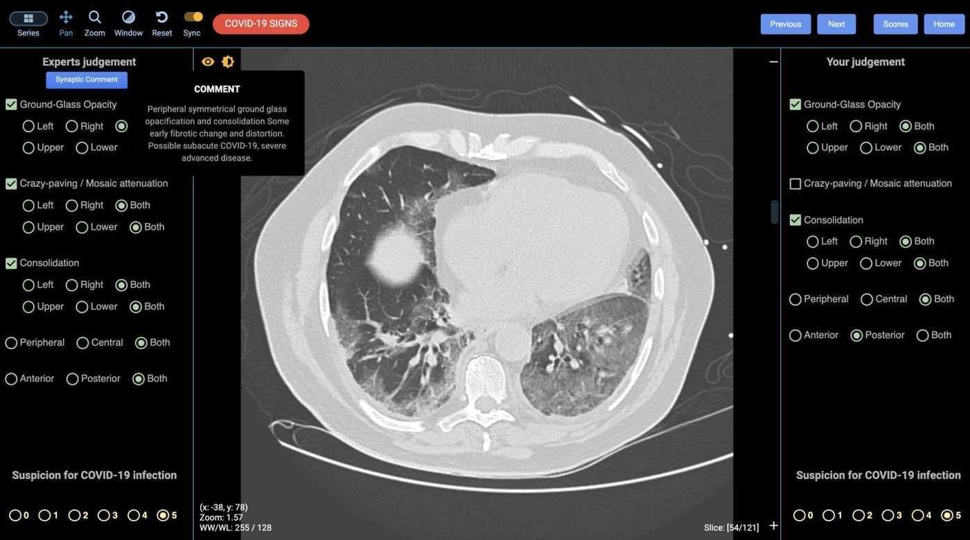 An image from the DetectED-X platform of a lung with indications of severe COVID-19 / Credit: DetectED-X