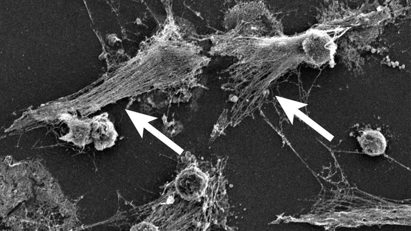 Part of the body's immune system, neutrophils detect bacteria and can expel their DNA (see arrows) to attack the bacteria with a gauzy web of DNA laced with toxic enzymes, called a NET. / Credit: Egeblad lab/CSHL