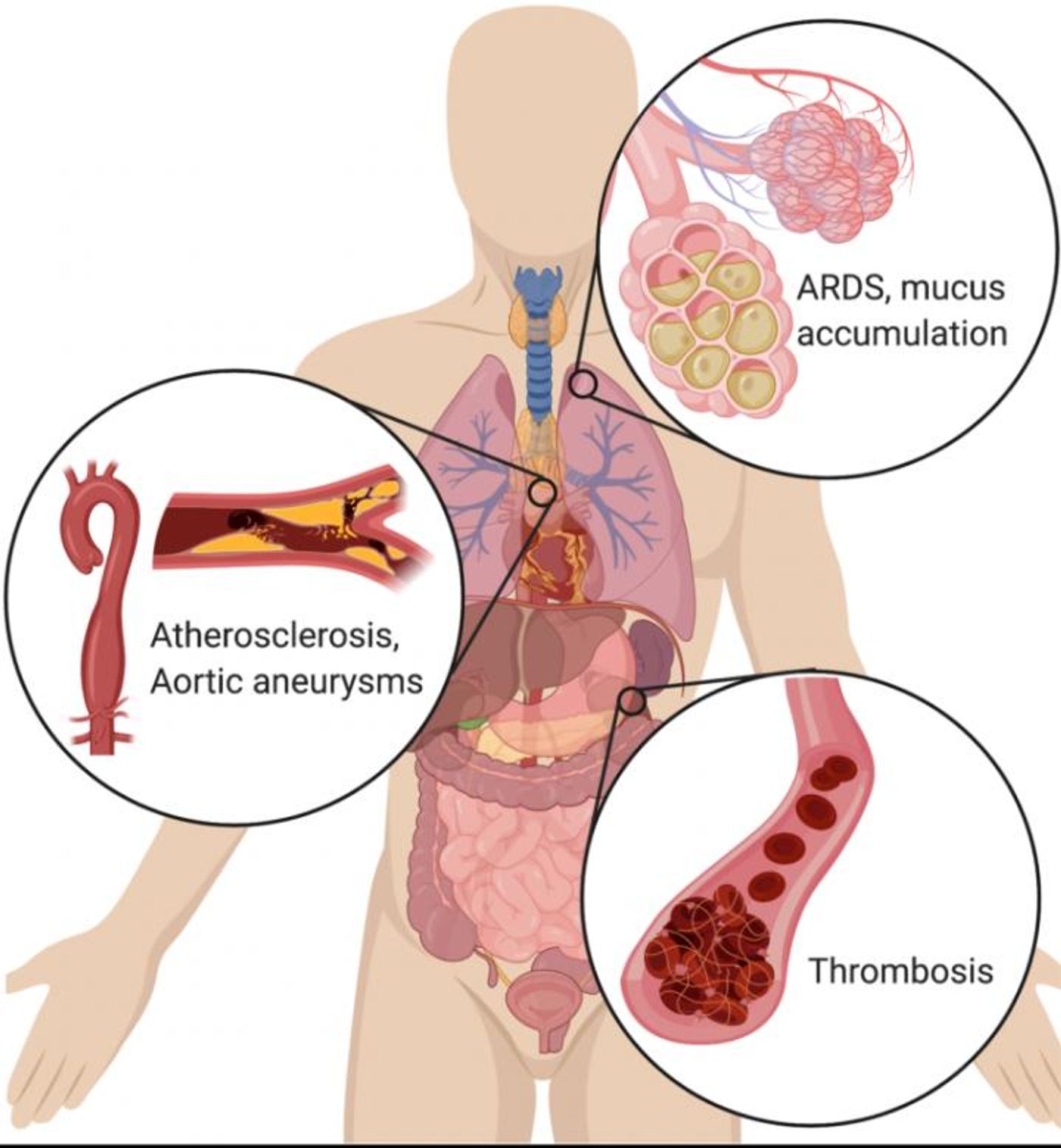 In the lungs, NETs drive the accumulation of mucus in cystic fibrosis patients' airways. NETs also drive acute respiratory distress syndrome (ARDS) after a variety of inducers, including influenza. In the vascular system, NETs drive atherosclerosis and aortic aneurysms, as well as thrombosis (particularly microthrombosis), with devastating effects on organ function. BioRender was used to generate the illustration. / Credit: CSHL