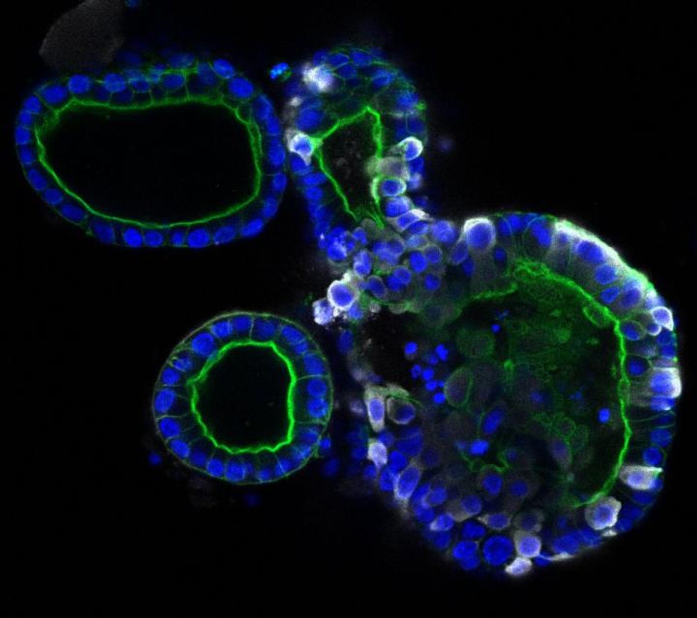 Intestinal organoids, the right one infected with coronavirus SARS-CoV-2. The coronavirus is colored white, the organoids themselves are colored blue and green. / Credit: Joep Beumer, copyright Hubrecht Institue