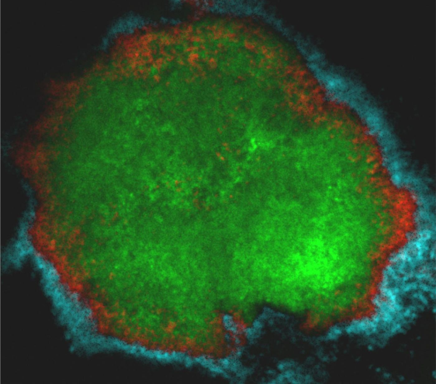 Researchers from the University of Pennsylvania found that the bacteria responsible for tooth decay "shields" itself under blankets of sugars and other bacteria in a crown-like arrangement, helping it evade antimicrobials and concentrate its tooth-damaging acids. / Credit: Dongyeop Kim