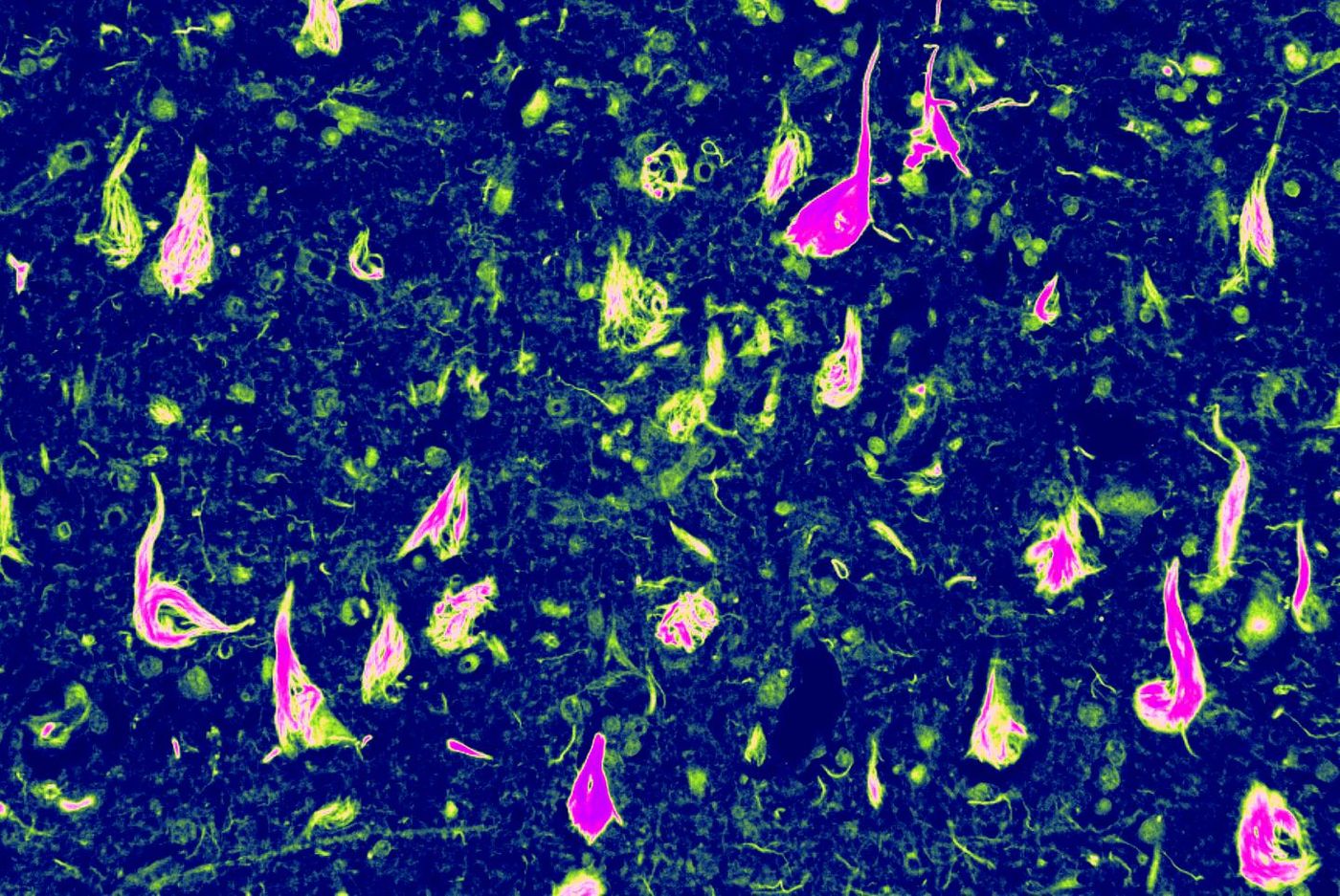 Abnormal neurofibrillary tangles (NFTs) -- a buildup of tau protein in parts of the brain -- helped Edward Lee, MD, PhD, an assistant professor of Pathology and Laboratory Medicine, and other Penn Medicine scientists uncover this new form of dementia. / Credit: Edward Lee