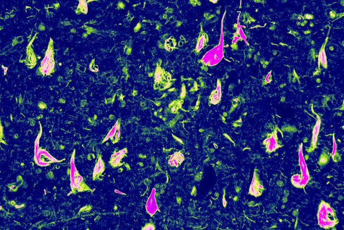 Abnormal neurofibrillary tangles (NFTs) -- a buildup of tau protein in parts of the brain -- helped Edward Lee, MD, PhD, an assistant professor of Pathology and Laboratory Medicine, and other Penn Medicine scientists uncover this new form of dementia. / Credit: Edward Lee