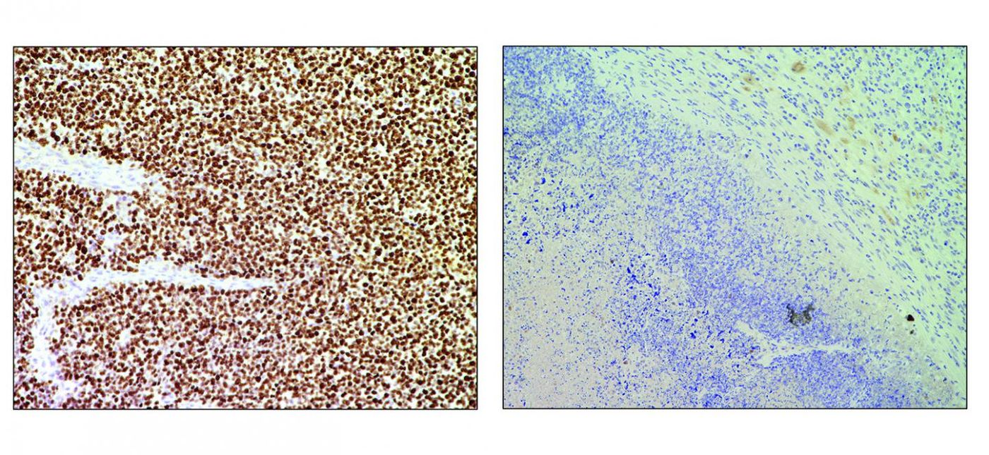 An untreated tumour on the left and on the right, a CRISPR-treated tumor. Cells are stained with a cell proliferation marker (Ki67); brown shows cells in the untreated tumour proliferating, but not in the CRISPR-treated tumour / Credit: CNIO