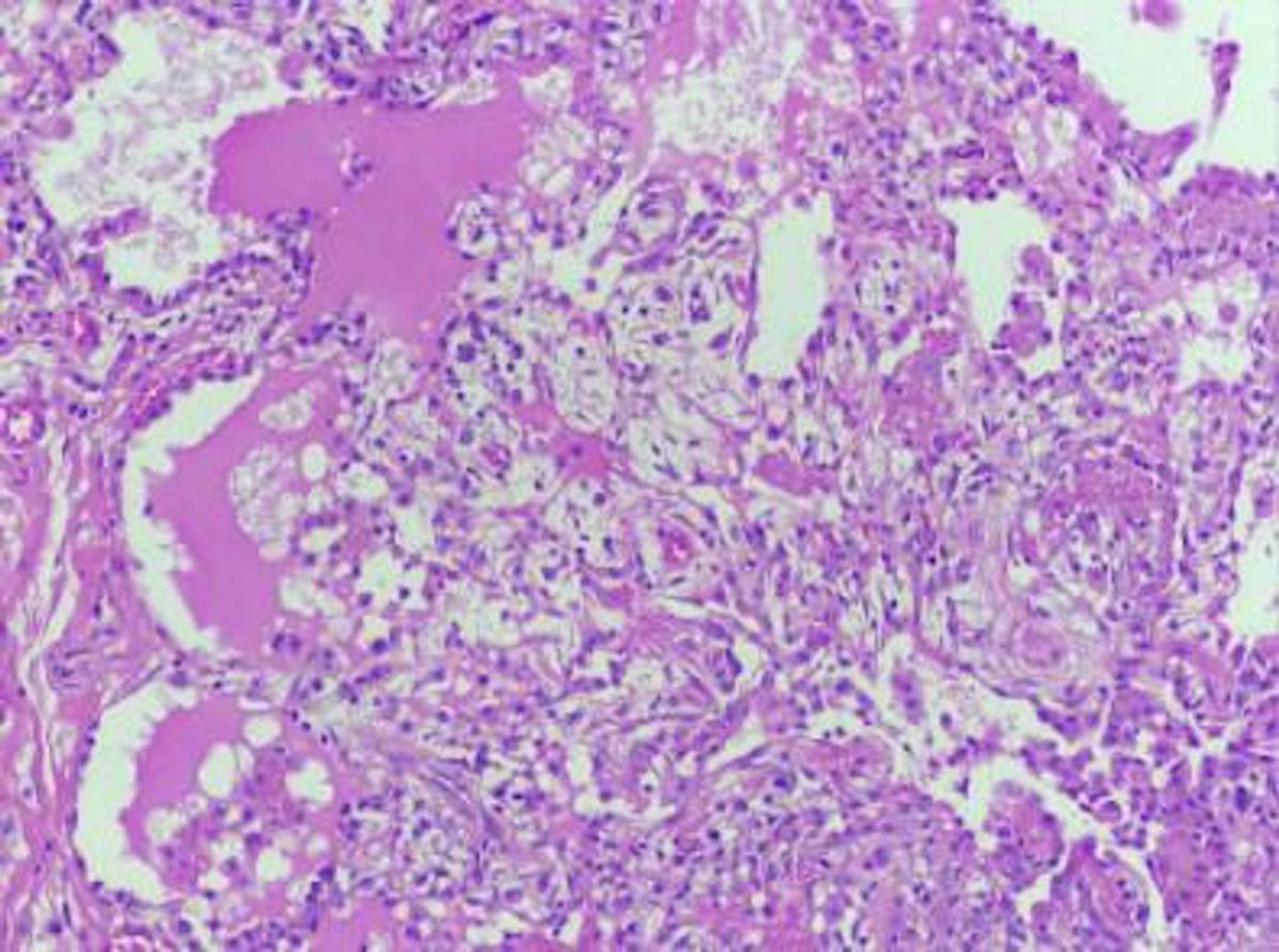Lung tissue from patient with GATA2 deficiency, displaying pulmonary alveolar proteinosis and inflammatory lymphoplasmacytic infiltrate / Credit: CTC