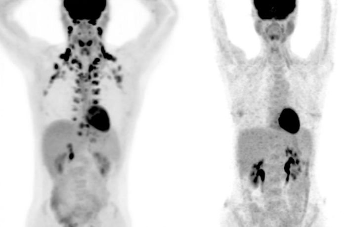 PET scans: at left the person has abundant brown fat around the neck and cervical spine, while on the right, there is no detectable brown fat. / Credit: Courtesy of MSKCC radiologists Andreas G. Wibmer and Heiko Schöder