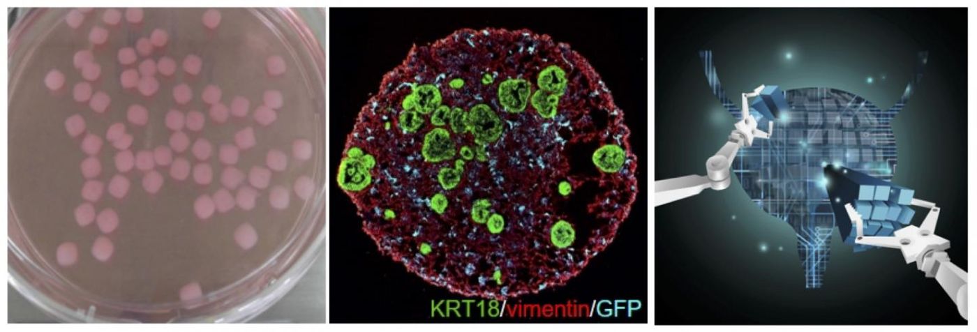 Patient-derived bladder tumor assembloid, an in vitro tumor tissue that mimics the pathological features of the human bladder cancer. / Credit  Kunyoo Shin (POSTECH)