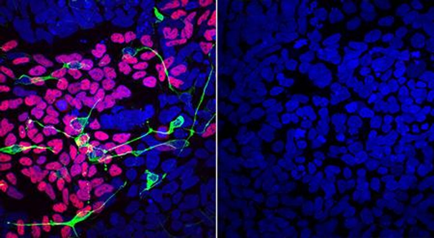 Compared to a disease-free mother (left), differentiated LINKED patient cells (right) lack markers of normal development of the brain, spinal cord and craniofacial skeleton (pink, green, yellow). Credit  Werner lab, NIDCR