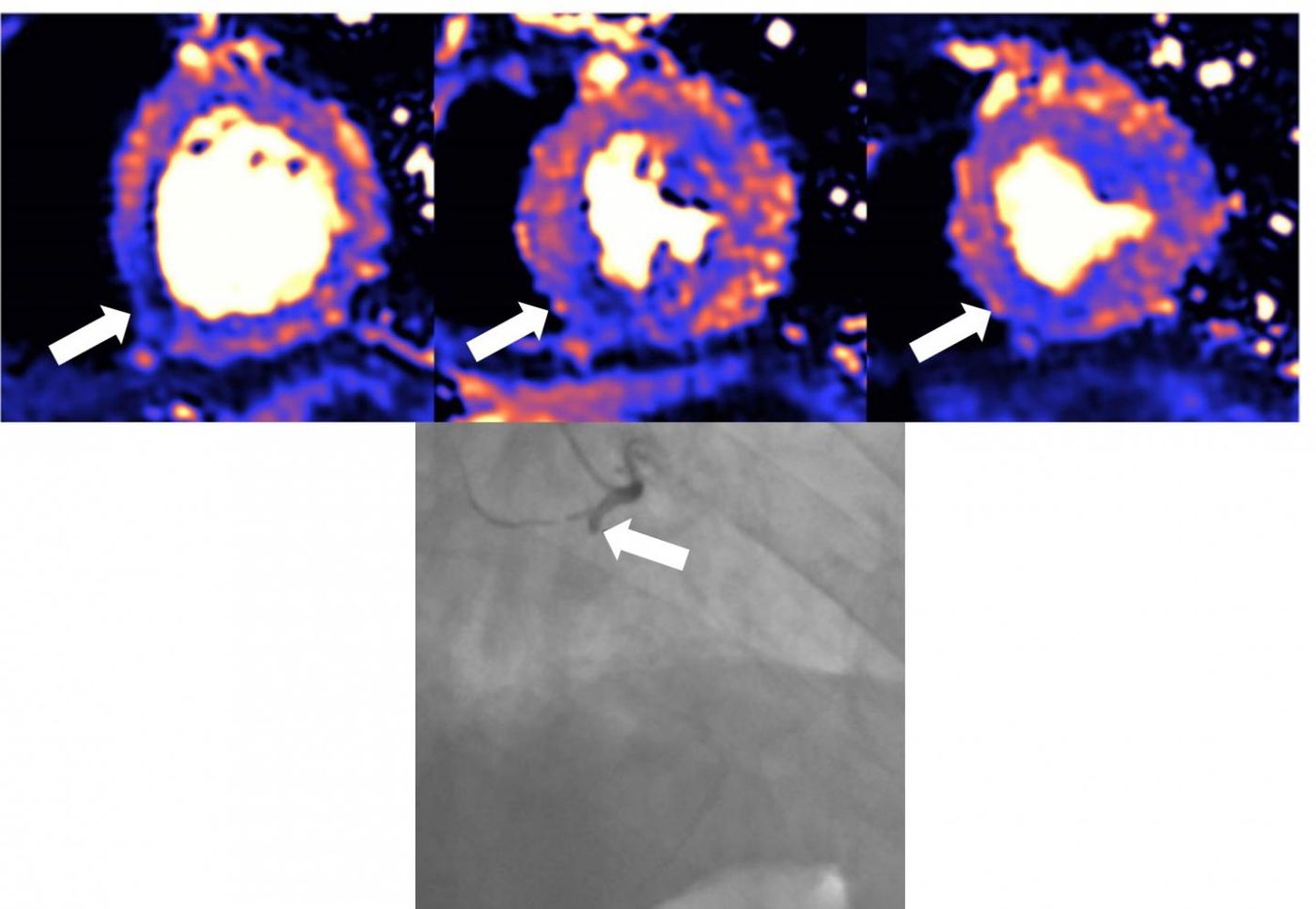 MRI scan of a damaged heart. Blue indicates reduced blood flow, while orange is good. The dark blue shows myocardial blood flow is very reduced. Black and white angiography shows that the blood vessel supplying blood to this area is occluded. / Credit: European Heart Journal