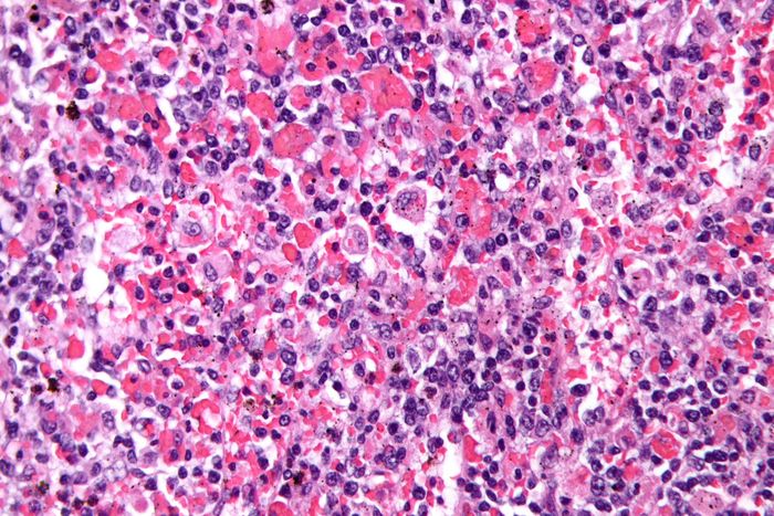 High magnification micrograph from patient with Hemophagocytic lymphohistiocytosis. Source: Nephron