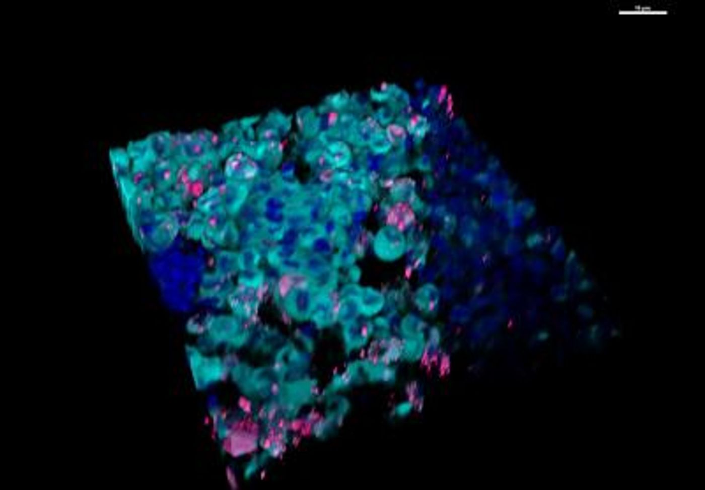 This 3D image of human breast cancer bone metastases shows the formation of the newly described organelle (magenta) in cancer cells (cyan). Cell nuclei from both cancer cells and normal bone cells are labeled in blue. / Credit: Image rendering by Mark Esposito and Gary Laevsky