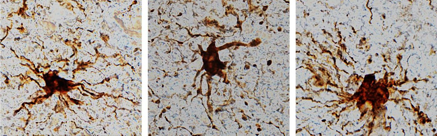 'Zombie' cells come to life after the death of the human brain./Credit: Dr. Jeffrey Loeb/UIC