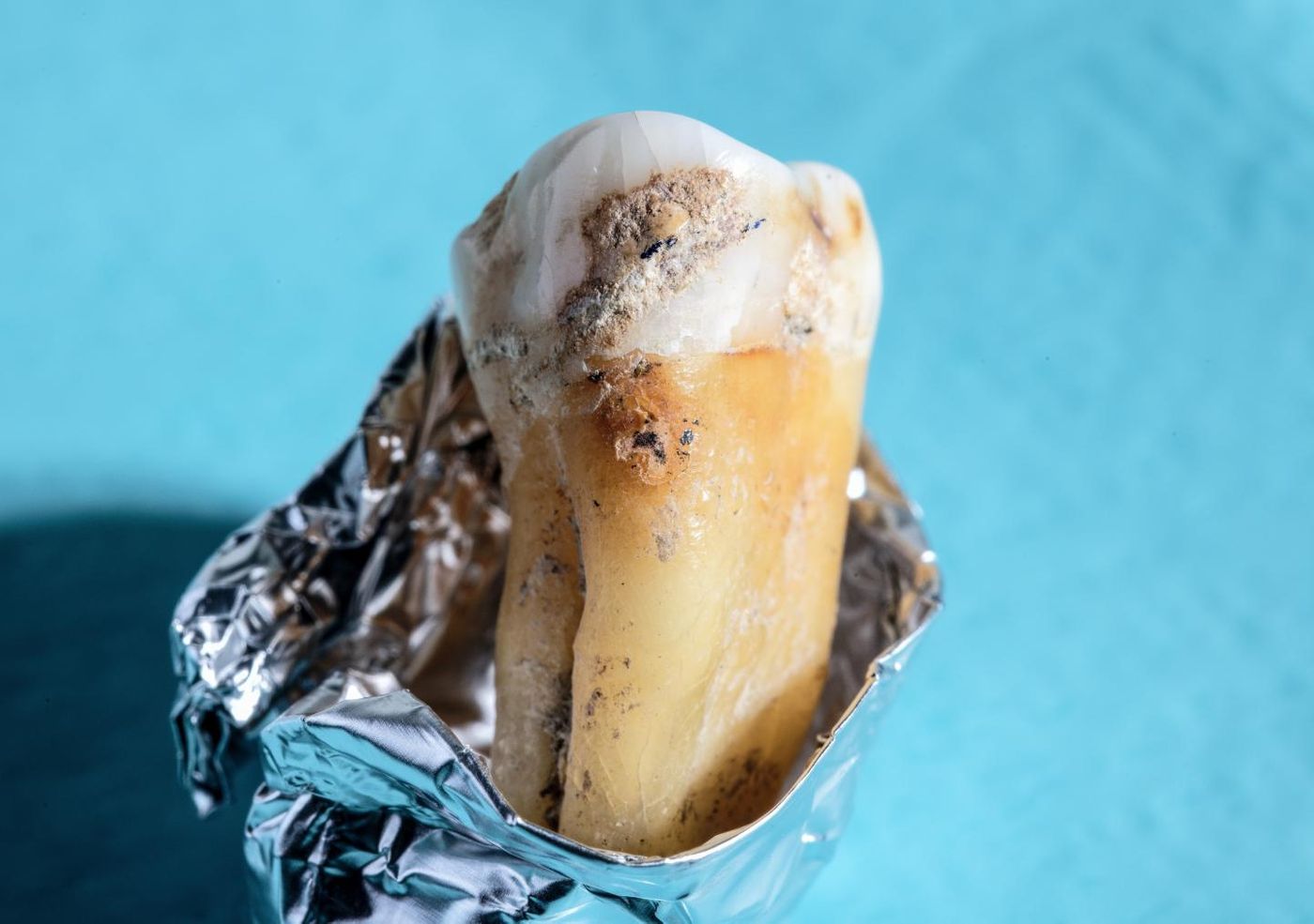 Close-up of ancient dental calculus on an ancient human tooth. / Credit: Werner Siemens Foundation, Felix Wey