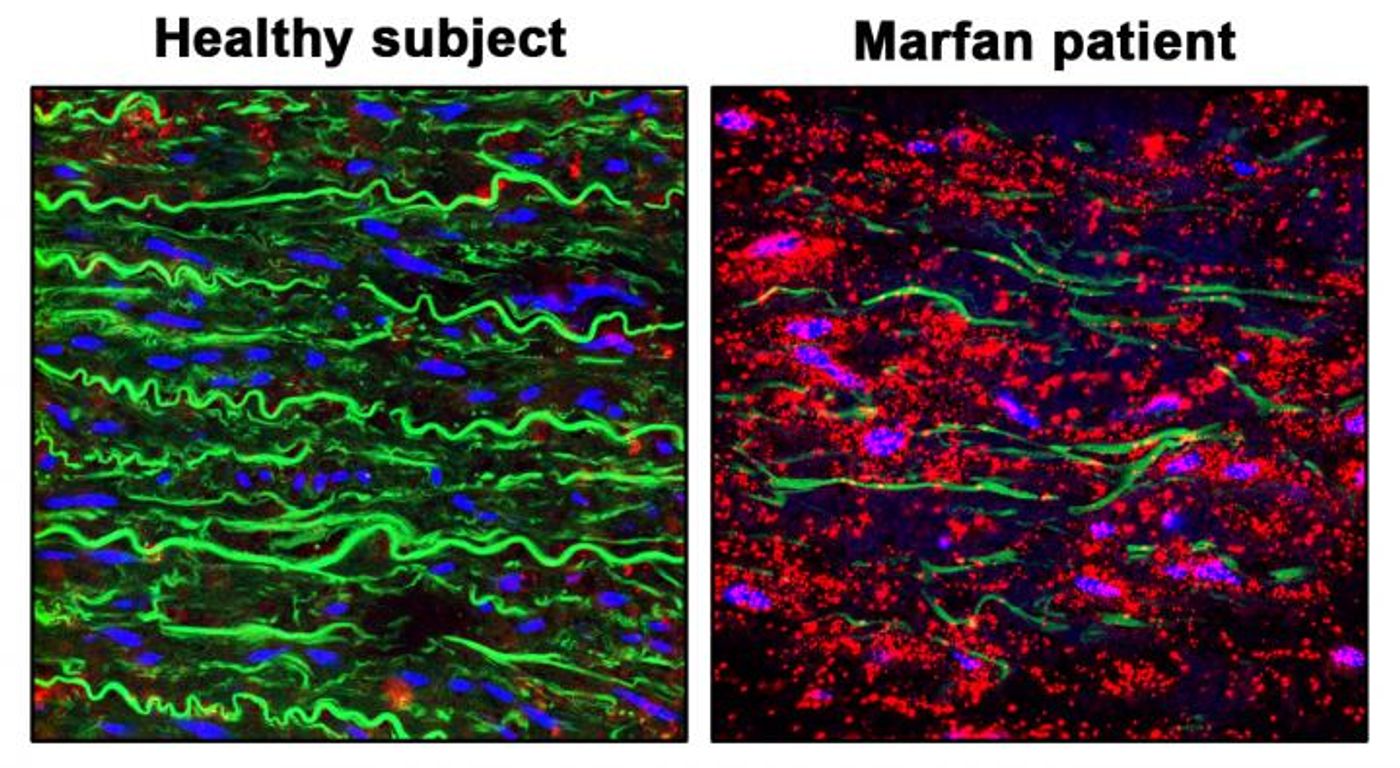 Staining showing pVASP-S239 (red), elastic fibers (green) and nuclei (blue) in the aortic wall of a healthy donor (Healthy Aorta) and a patient with Marfan Syndrome (Diseased Aorta from Marfan Patient). The images show how the NO-sGC-PRKGI pathway is over-activated in the aortic wall from Marfan patiens. / Credit: CNIC/ CSIC