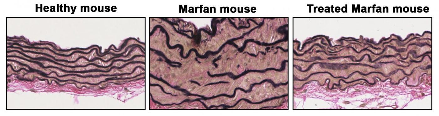 Aortic sections show disarrayed elastic fibers (black lines), thick vascular wall in Marfan mouse, reverts when Prkg1 protein is reduced. / Credit: CNIC/CSIC