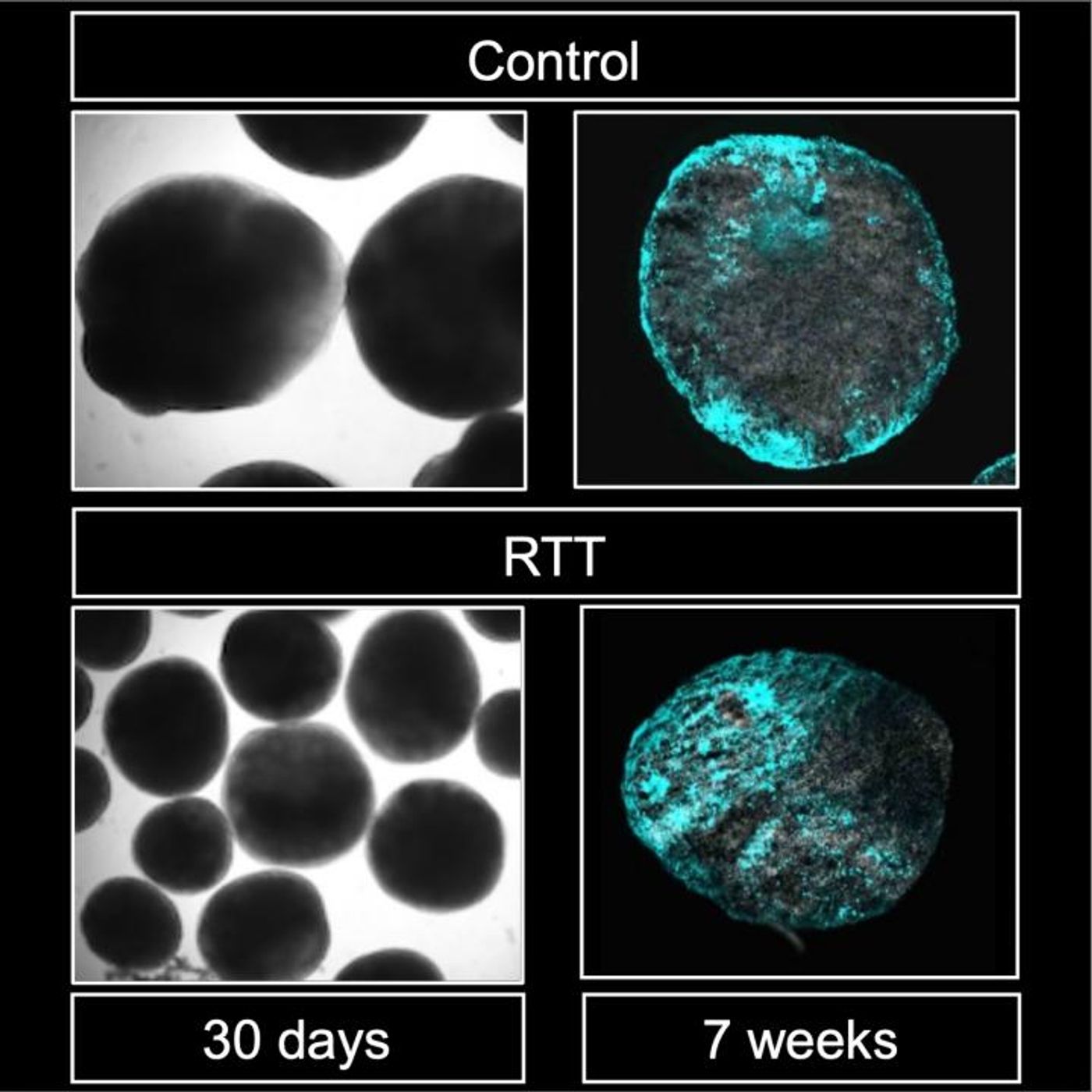 Brain organoids generated from control (top) and Rett syndrome (left) patients, including astrocytes (cyan). Color intensity is higher in Rett-derived organoids./ Credit: Kyushu University/Nakashima Lab