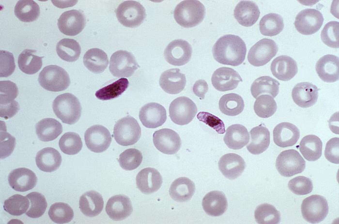 Malaria Parasite Seems to be Evolving to Evade Diagnostic Tests ...