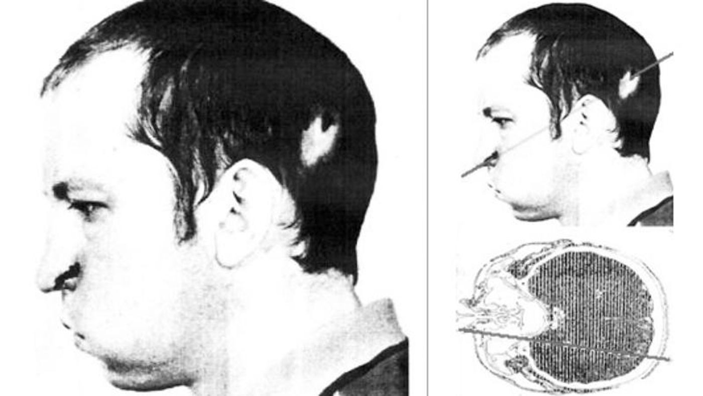 Photo of Bugorski's facial injury (Curiosity)