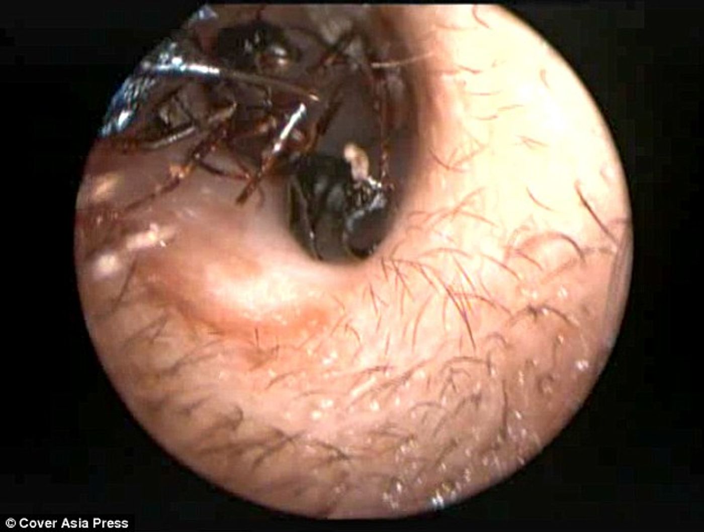 Ants are removed from the girl's ears in a procedure.