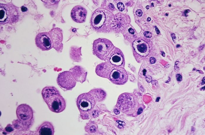CMV infected pneumocytes. Source: Dr. Yale Rosen