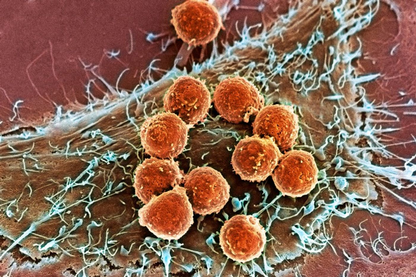 Scanning electron microscope image of immune cells attacking a cancer cell (mskcc.org)