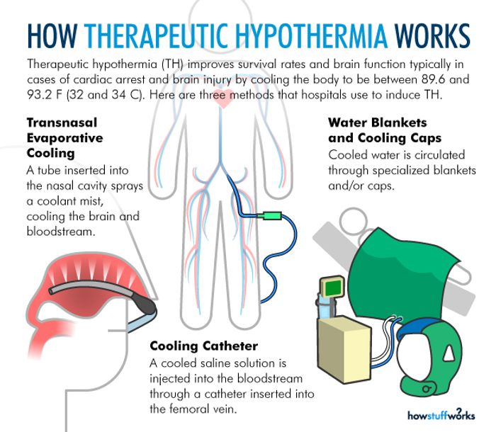 Therapeutic Hypothermia Saves Cardiac Arrest Patients Cardiology
