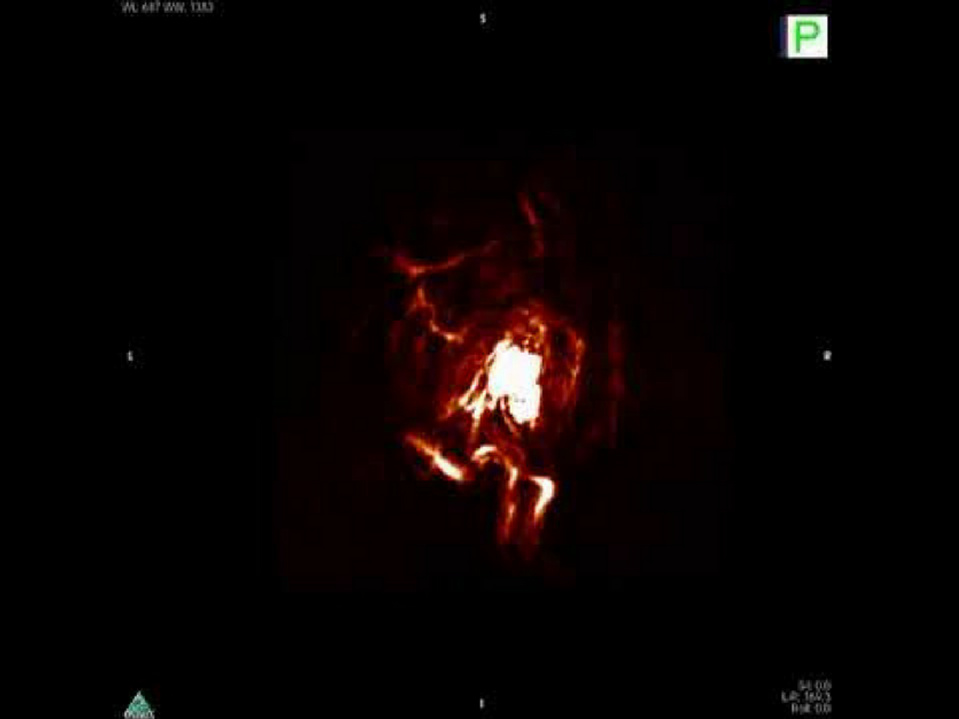 A hypoxic tumor illuminated by molecular beacon under photoacoustic imaging. Credit: ChanLab/UIUC