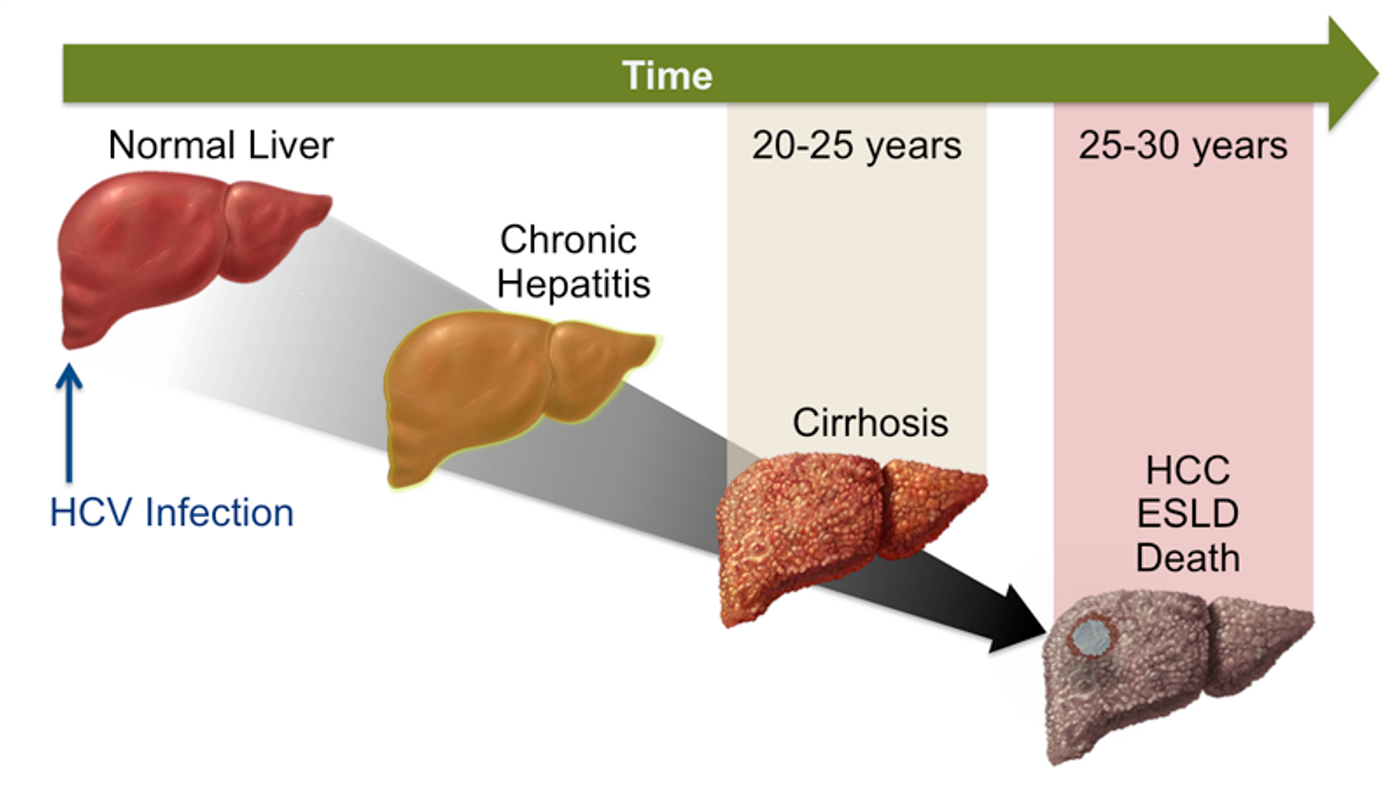 A Time Course Progression of a Chronic Hepatitis C Infection