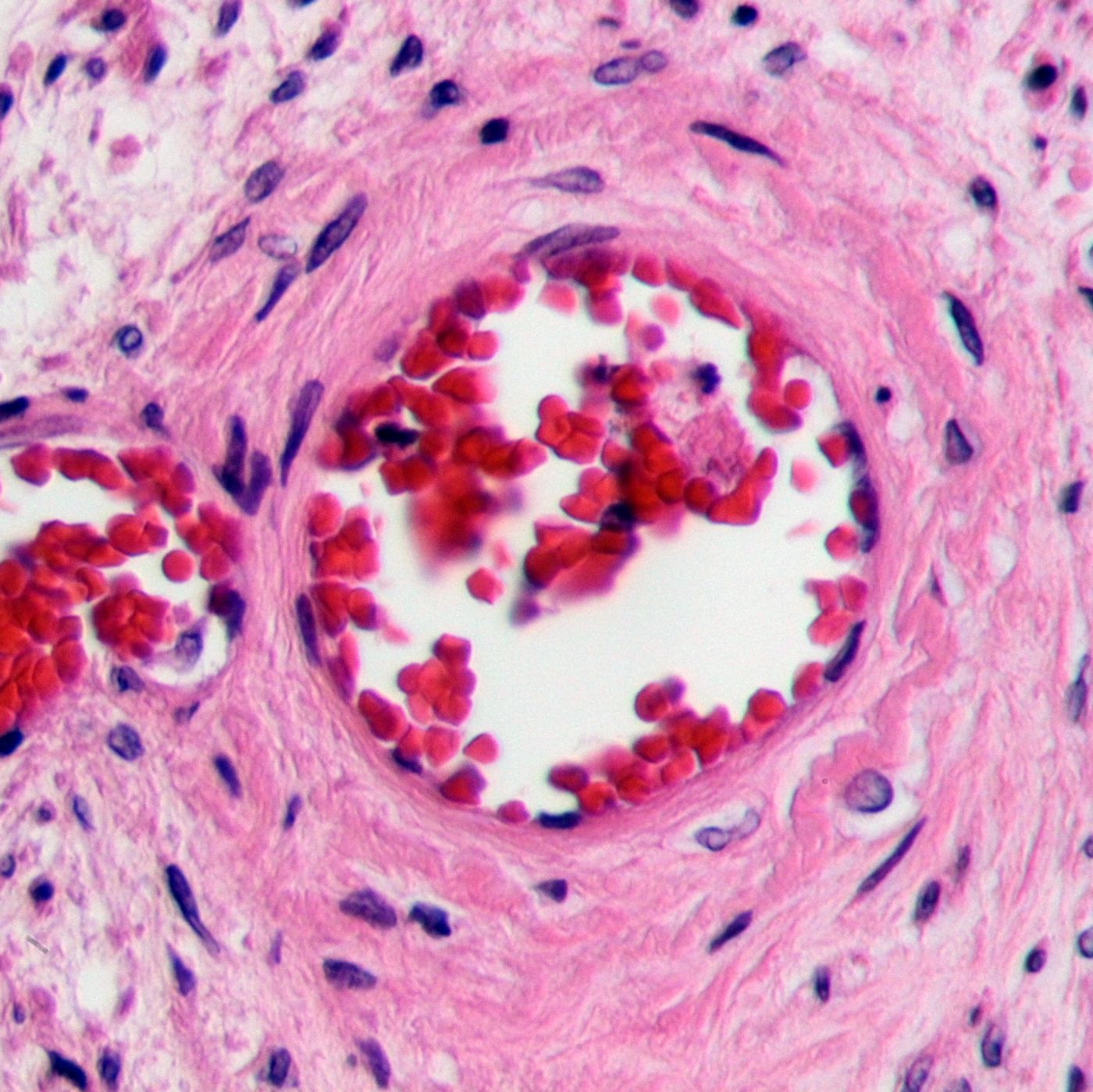 Newly formed blood vessel within an occluded artery of the lower leg	