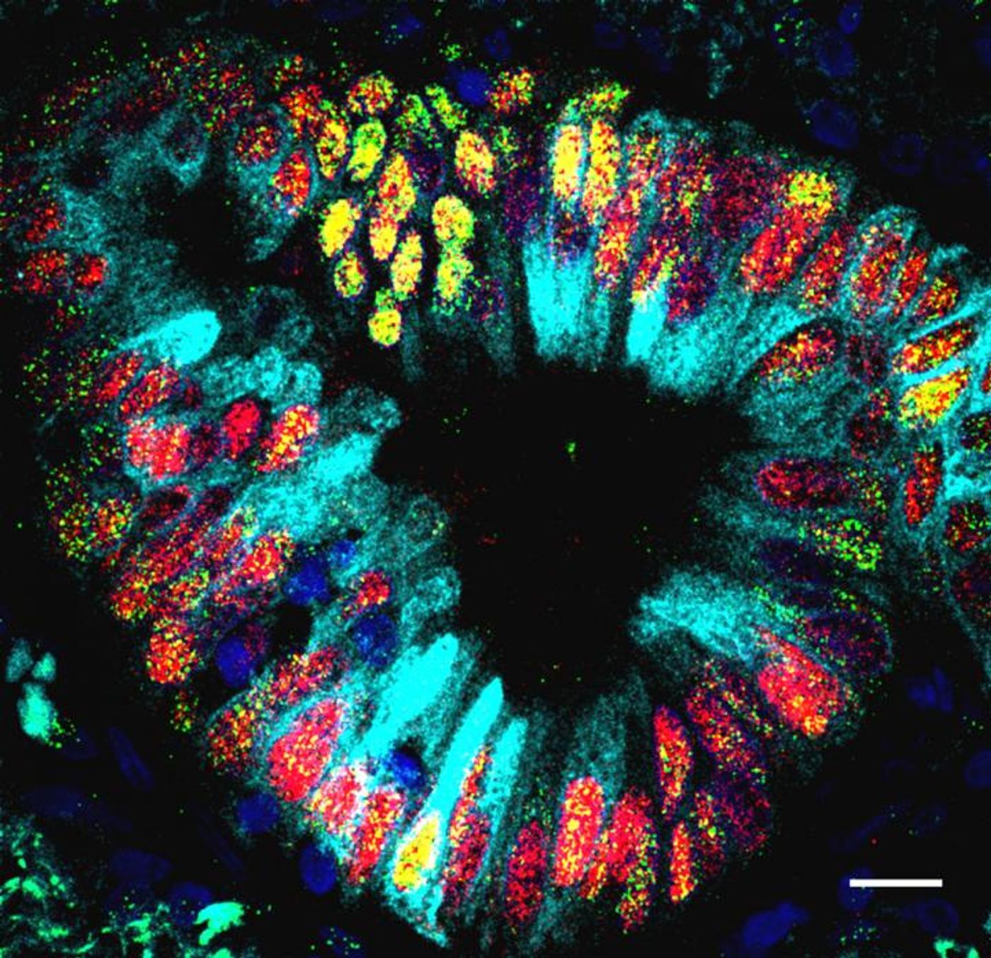 Staining for specific transcription factors reveals that this lung tumor also includes cells characteristic of the duodenum and intestine. New research from Duke has found that some lung cancer cells with errors in transcription factors begin to resemble their nearest relatives - the cells of the stomach and gut. / Credit: Tata Lab, Duke University