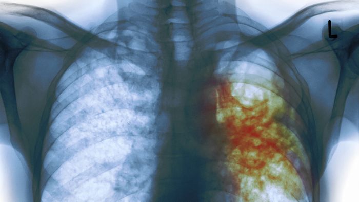An X-ray of the chest of a man with tuberculosis