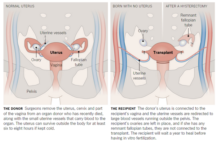 Uterus Transplant