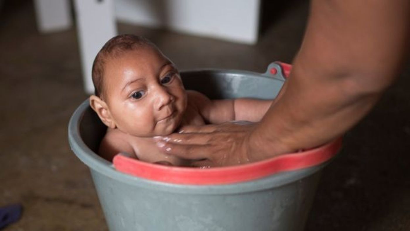 A baby born with microcephaly in Brazil