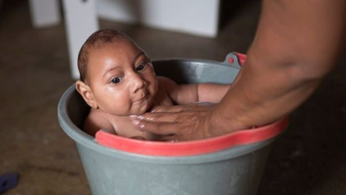 A baby born with microcephaly in Brazil