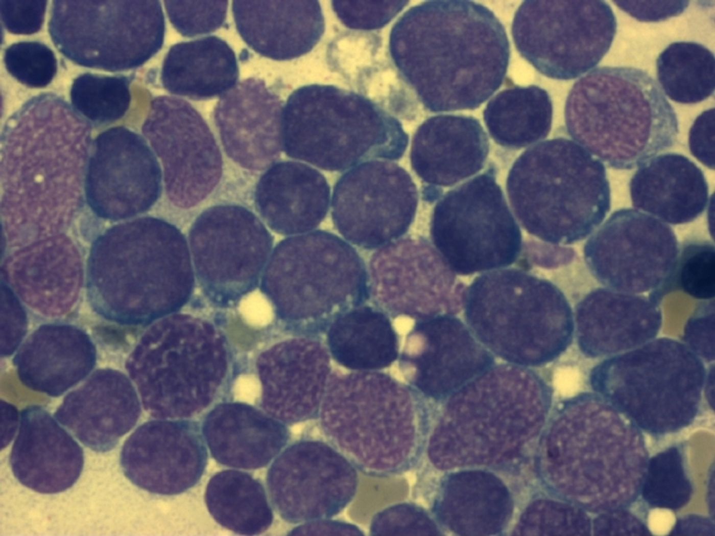Bone marrow smear (large magnification) from a patient with acute lymphoblastic leukemia / Credit: WikimediaCommons/Furfur
