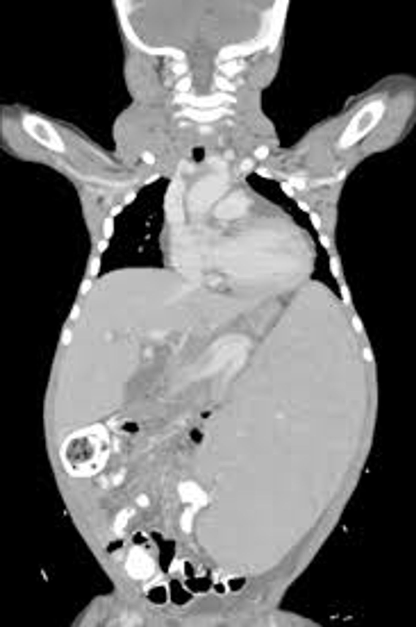 A PET scan of an ALPS patient