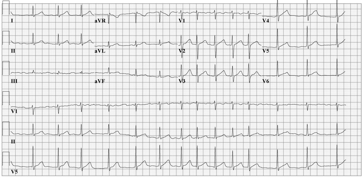 ECG results. Source: Cardio Networks