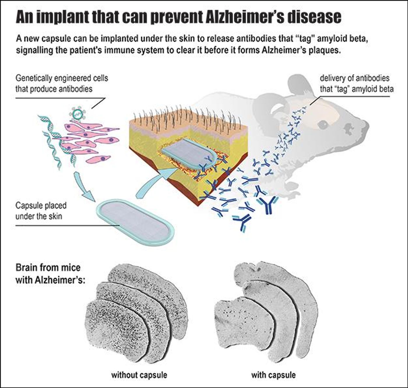 This is an infographic of how the implanted capsule releases antibodies to the brain.