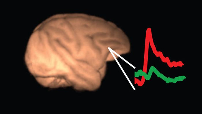 Amyloid PET imaging boosts early detection of Alzheimer's disease.