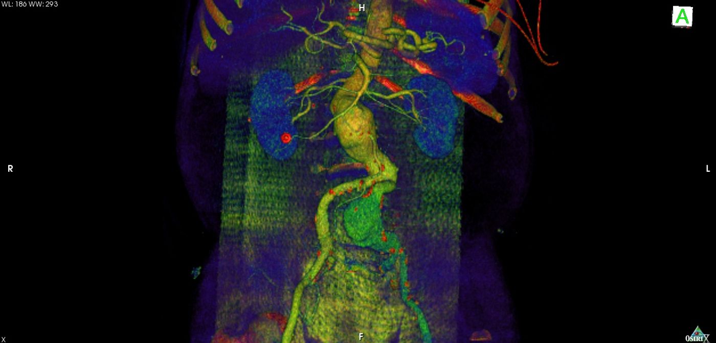 CT angiography of a patient with aneurysm of the abdominal aorta. Credit: Haudebourg
