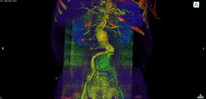 CT angiography of a patient with aneurysm of the abdominal aorta. Credit: Haudebourg