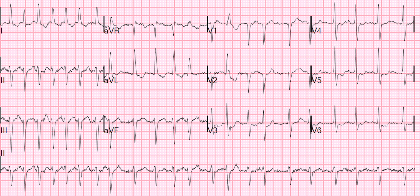 Source: Dr. Smith's ECG Blog