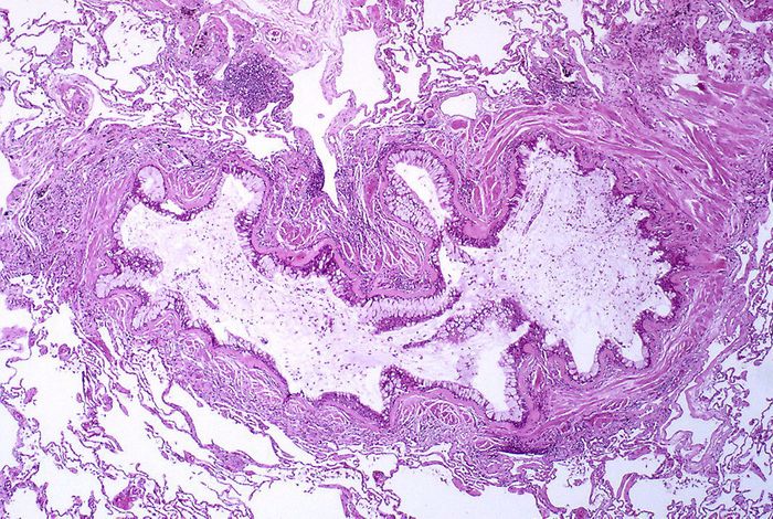 Obstruction and inflammation of the bronchiole characteristic of asthma. Credit: Yale Rosen