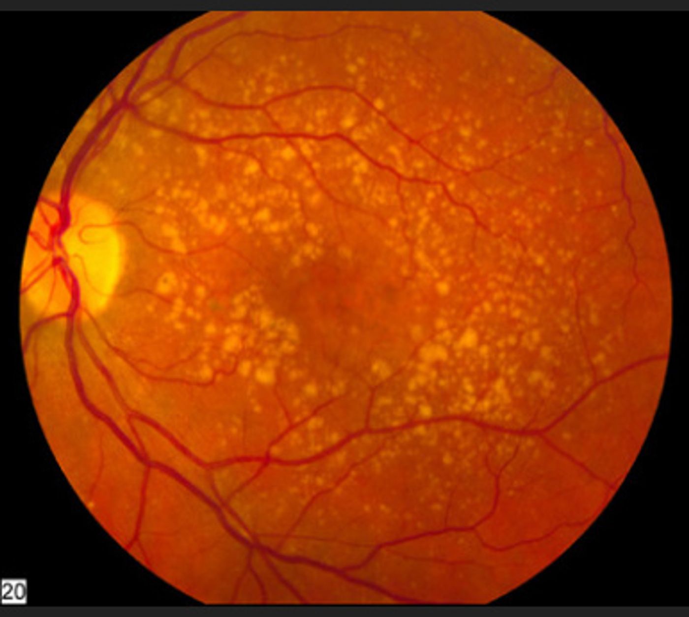 Age-Related Macular Degeneration  A fundus photo showing intermediate age-related macular degeneration. /Credit National Eye Institute, National Institutes of Health.